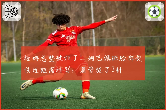 给姆总整破相了!姆巴佩晒脸部受伤近距离特写,眉骨缝了3针